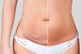 Want to Get a Flat Abdomen? A Tummy Tuck Can Help!