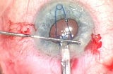 Complex Cases, Simplified (2): Malyugin Ring 2.0 plays an expanding role in small pupil surgery
