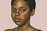 My acne and me. Me against myself.