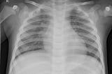 Python VAE and generating X-Ray Data