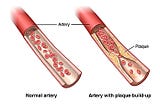 Coronary Artery Disease: Causes, Symptoms, and
Treatments.