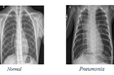 Image Classification of X-Ray Scans