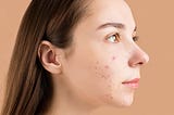 Acne Pimple Patches Do They Really Work?