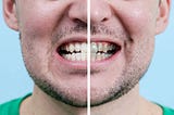 A Brighter Smile: Exploring Tooth Whitening and Bleaching Techniques