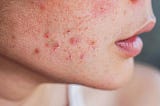 Myths vs. Facts: Debunking Common Misconceptions About Professional Acne Treatment in Hyderabad