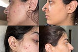 It Took Me 4 Weeks To Overcome My Lifelong Acne — Here’s How