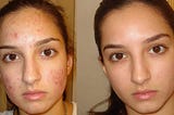 Cannabis Can Help Cure Acne