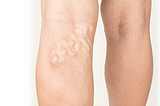 Why Suffer from Ugly Varicose Veins?