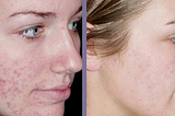 Revitol Scar Cream Review: Fact Be Told