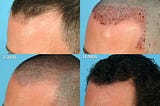 Hair transplant in Delhi, Why it is the best therapy for Hair loss or Baldness