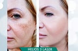 Laser Treatment Utilizes Centered Light Emissions To Treat Harmed Territories On The Body