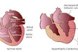 High Blood Pressure and Hypertensive Heart Disease