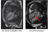 Brief Review — Automatic Left Ventricular Outflow Tract Classification for Accurate Cardiac MR…