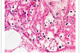 Mucormycosis : Rare fungal infection linked to corona virus