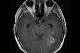 Brain Tumour Classification using Convolutional Neural Networks