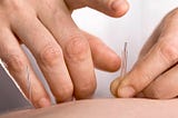 Benefits Of Fertility Acupuncture.