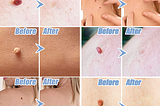 Skin Flab Pen To Get Rid of Moles To Get Rid of Chicken EyesTo Get Rid of Warts 2 In 1 Can Change…