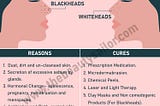 Blackheads And Whiteheads : Causes & Treatment