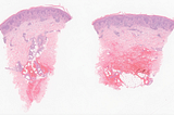 Mycoses Fungoides