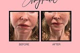 Do Fillers Reshape Your Jawline and Remove the Double Chin?