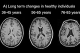 Brain changes over the lifespan.