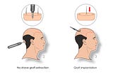 How Much Do Hair Implants Cost in Turkey?