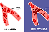 illustrations of blood vessels when the cells are normal and easily flow and when there are sickled cells and the vessels are blocked.