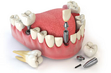Dental Implants in Oak Park, IL