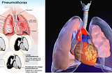 SIIM-ACR Pneumothorax Segmentation