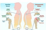 Pilates and Yoga Are Cute – But They Won’t Cure Your Osteoporosis