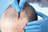 Hair Transplant in Bhubaneswar