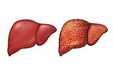 All the Causes of Liver Cirrhosis