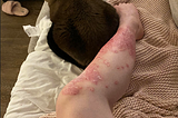 Biologics for Psoriasis with Least Side Effects ?