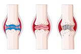 Rheumatoid Arthritis Treatment