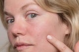 Ask Curology: How do I get rid of acne scars?