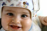 What is plagiocephaly?