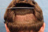 Fue Hair Transplant Cost Turkey