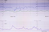 My Experience with SVT and Getting an Ablation