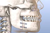 Introduction to Orthognathic Treatment