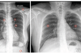 Brief Review — Deep Neural Network for Foreign Object Detection in Chest X-rays