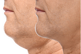 Explore the Magic of Double Chin Removal with Kybella Treatment