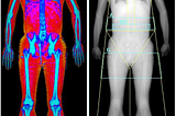A tale of two DEXA scans