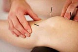 Acupuncture and its benefits.