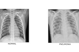 Detecção de Pneumonia com Deep Learning