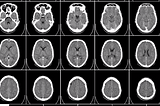 AI, ML AND DEEP LEARNING IN HEALTHCARE SECTOR