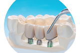COST OF DENTAL IMPLANTS IN BANGALORE, INDIA
