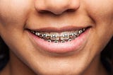 Why Every Teenager Should Consider Seeing an Orthodontist