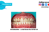 Periodontitis — themediblogs|best medical blogs website