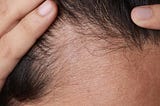 The Leading Causes of Premature Hair Loss: A Professional Approach