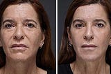 Rejuvenate 12 years in 2 weeks, naturally! No Botox or plastic surgery